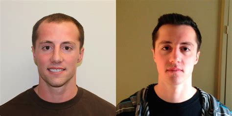 Hair plug is accepted as one form of hair transplant. Young Man Flies In From California To Have A MaxHarvest ...