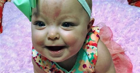 Baby Girl Born With Massive Adult Sized Tongue Smiles For First Time