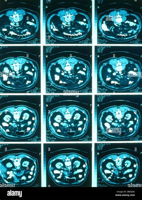 Abdominal Scan Hi Res Stock Photography And Images Alamy