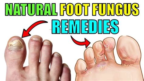 Home Remedies To Cure Toenail And Foot Fungus Naturally Epic Natural
