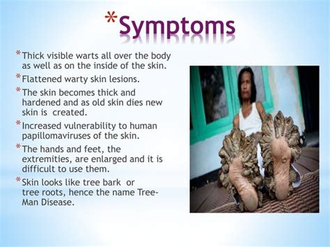 Tree Man Disease Epidermodysplasia Verruciformis