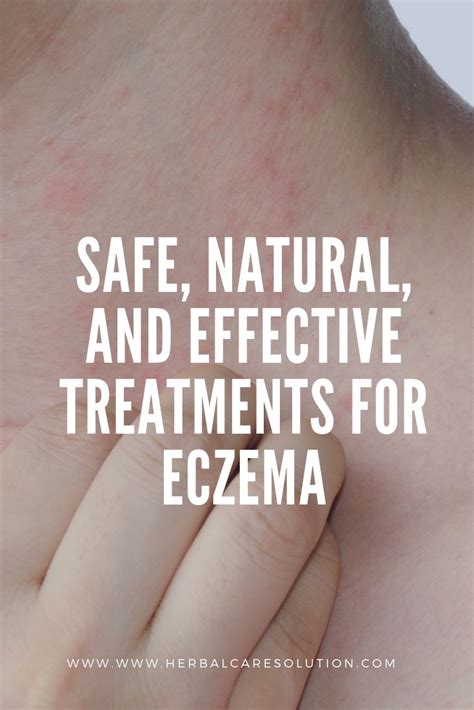 Safe Natural And Effective Treatments For Eczema Herbal Care