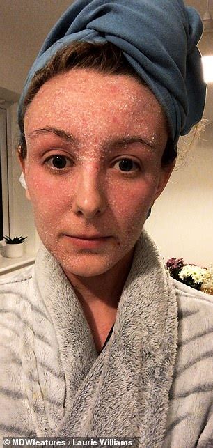 Eczema Sufferer Endures Flaking Skin Since Ditching Her Steroid Creams Daily Mail Online