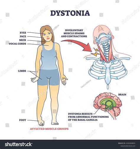 Dystonia Disorder Abnormal Muscle Spasms Contractions Stock Vector
