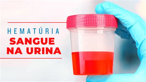 Sangue na urina Hematúria Dr Renato Gagliardi