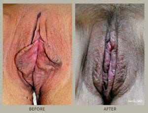 Labiaplasty Before And After Pictures Orlando Winter Park Fl