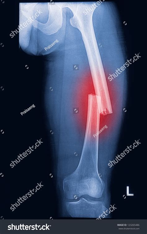 Broken Human Thigh Xrays Image Left Stock Photo 123265486 Shutterstock