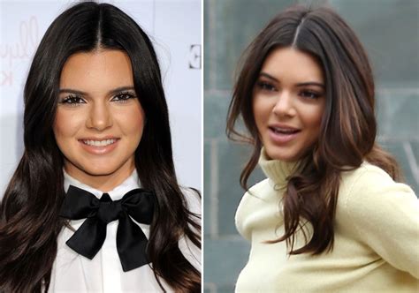 Kendall Jenner Before And After Plastic Surgery 02 Celebrity Plastic
