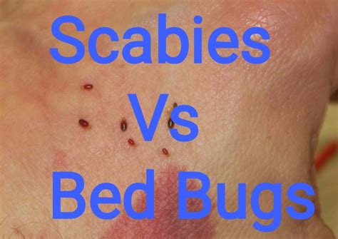 Scabies Vs Bed Bugs Bites Symptoms And Treatments
