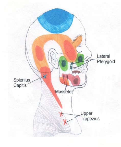 Head Neck And Shoulder Trigger Point Chart 1 © Copyright American Academy Of Manual Medicine