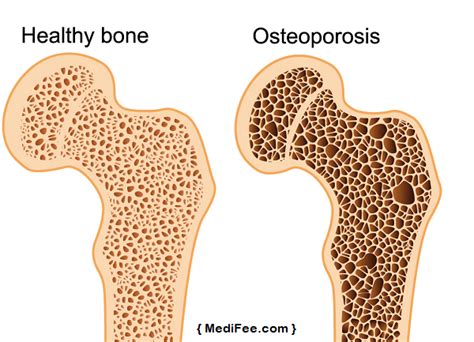 Osteoporosis Osteoporosis Types Causes Diagnosis And Preventive