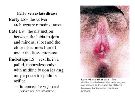 Clitoris Yeast Infection Adult Archive Comments