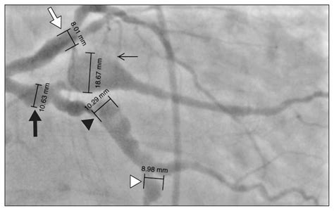 Giant And Multivessel Aneurysms Of The Coronary Artery Cmaj