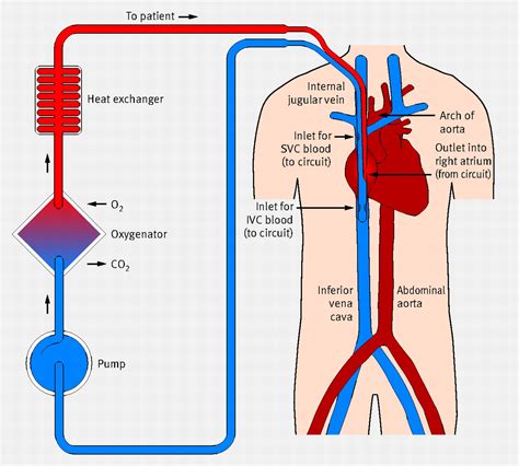 Extracorporeal Life Support The Bmj