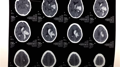 Ct Scan Intracerebral Hemorrhage With Intraventricular Extension
