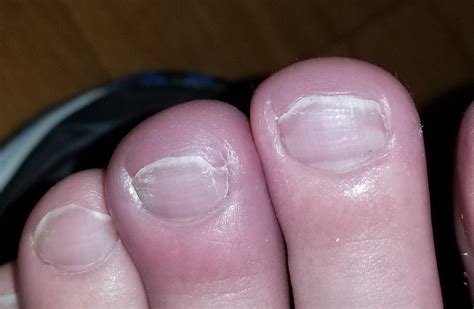 Redness Swelling Pain To Middle Toe And To A Less Extent Index Toe