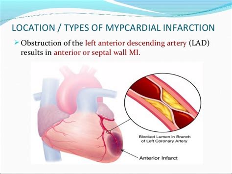 Myocardial Infarction