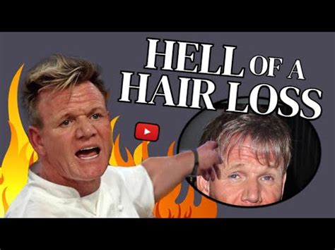 Gordon Ramsay S Hair Transplant Before And After Revealed How Did He