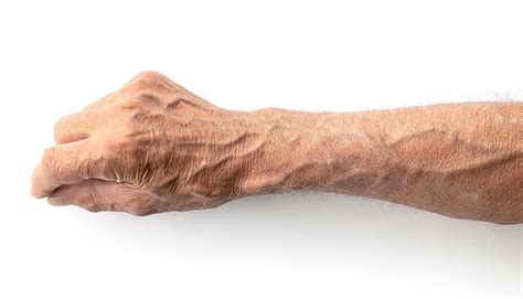 Case Study Covid 19 Brought On Blood Clots In Arm Futurity Everand