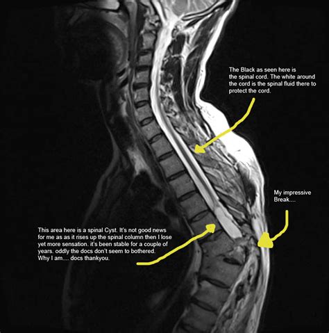Spine Cyst June 2010 Copy An Mri Scan Of My Spine Taken Ju Flickr