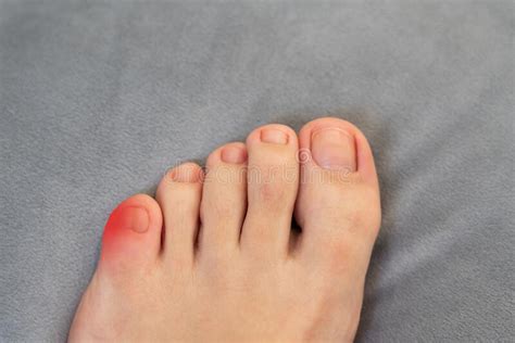 Inflammation On Female Foot With Red Spot Concept Of Feet Pain And
