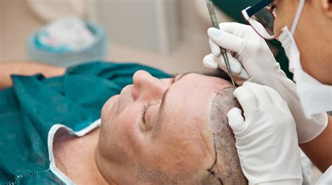 Hair Transplant Procedure Cost And Results Living Gossip