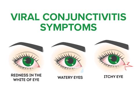 Signs And Symptoms Of Pink Eye Conjunctivitis