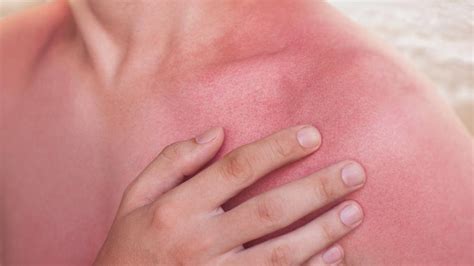 How Sunburn Causes Itchy Skin Symptoms Treatments And More Benadryl®