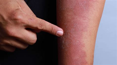 3 Ways To Get Rid Of Eczema And Prevent Flare Ups Business Insider India