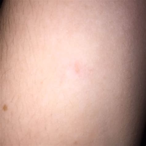 Very Itchy Little Pin Sized Raised Bumps All Over Body Mostly On