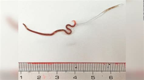 Doctors Remove Live Worm From Womans Tonsil Cnn
