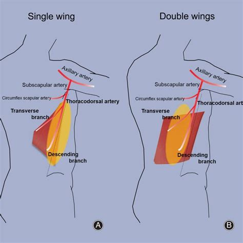 Schematic Diagram Of Design Variations Of The Extended Latissimus Dorsi