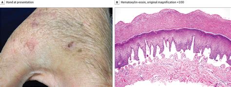Bullae And Erosions On Sun Exposed Skin Allergy And Clinical