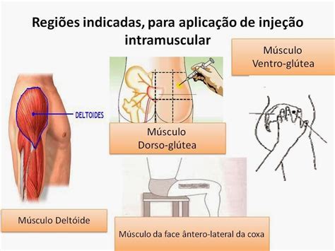 Quais São Os Músculos Utilizados Para Aplicação De Injeção Intramuscular
