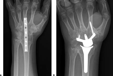 References In Clinical Outcomes Of Total Wrist Arthroplasty Journal