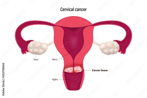 Cervical Cancer Cervix Carcinoma Female Reproductive System Disease
