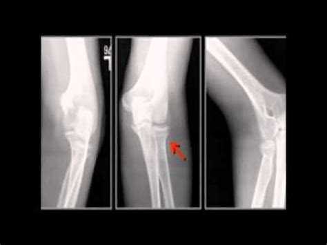 LearningRadiology 57 (Elbow Fractures-Dislocations) - YouTube