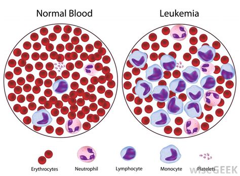 Acute Lymphoblastic Leukemia Ashpan Raskar Medium