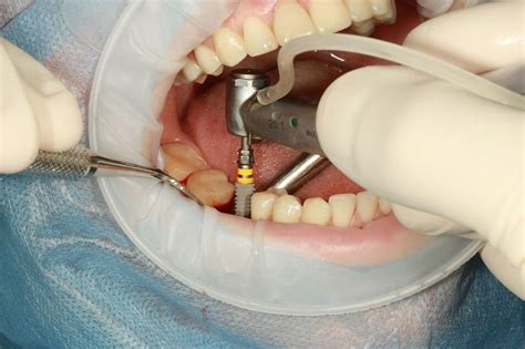 Todo Sobre Los Implantes Dentales Gu A Definitiva Y Beneficios