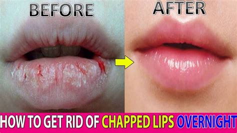 At Last How To Easily And Naturally Moisturize Chapped Lips Overnight