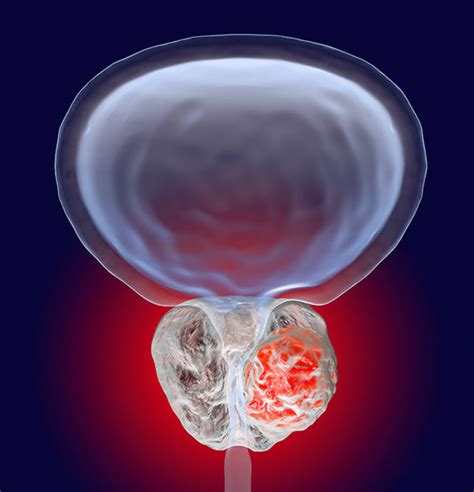 Symptoms of advanced prostate cancer include: Prostate cancer signs, symptoms and treatment: What are ...