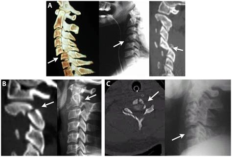 Management Of Acute Spinal Cord Injury Continuum Lifelong Learning