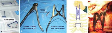 The Sternal Closure Device Scd A And Its Ancillary Instruments