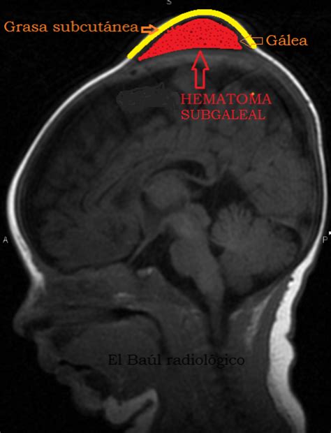 El Baúl Radiológico 2 Hematoma Subgaleal Hallazgos En TomografÍa