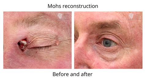 Before And After Mohs Surgery Mohs Surgery And Reconstruction