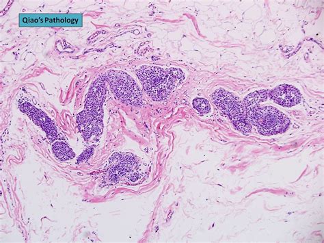 Lobular Carcinoma In Situ Lcis Flickr