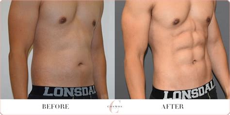 Male Vaser Hi Definition Liposuction And Costs Sydney Gold Coast Canberra And Adelaide