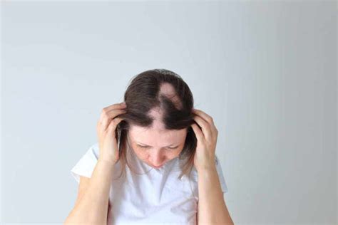 Alopecia Cause Sintomi E Come Riconoscerla Greenme