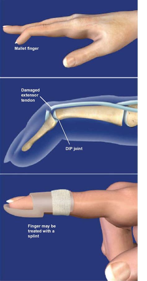 Mallet Finger Orthopaedic Associates Of Riverside