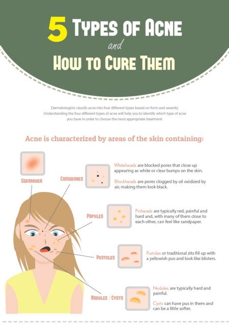 Acne Treatment Infographic